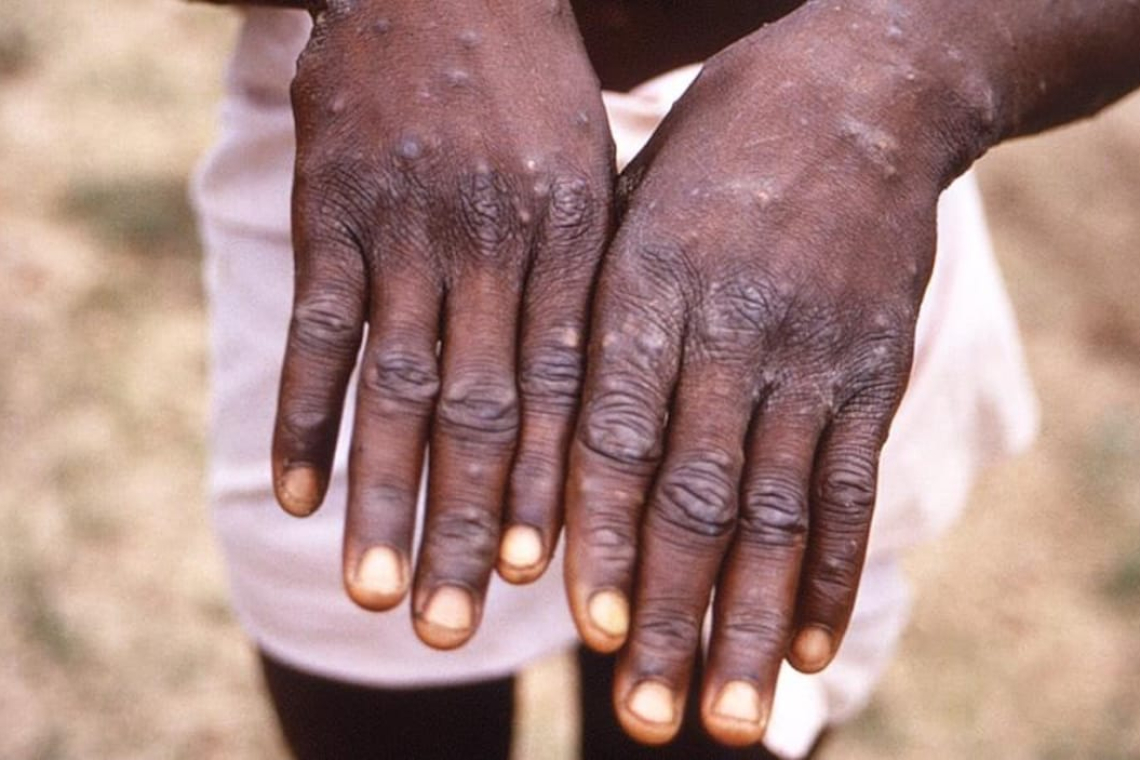 Trois cas de Monkey Pox enregistrés à l’Hôpital Général de Référence de Kinshasa mais la maladie est sous contrôle