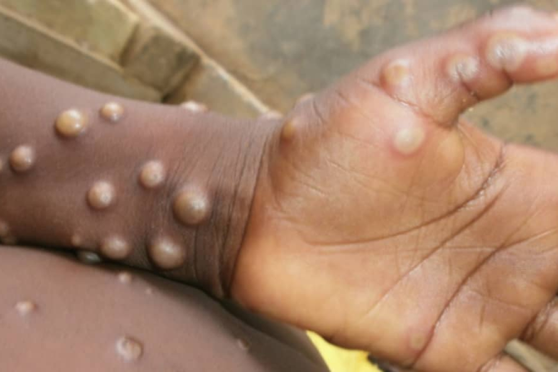 L'INRB précise qu'il n'y a pas de nouveaux cas des personnes atteintes de la maladie Monkey Pox