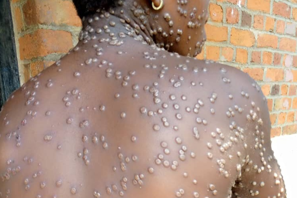 La RDC affronte le virus Mpox avec un plan de riposte holistique