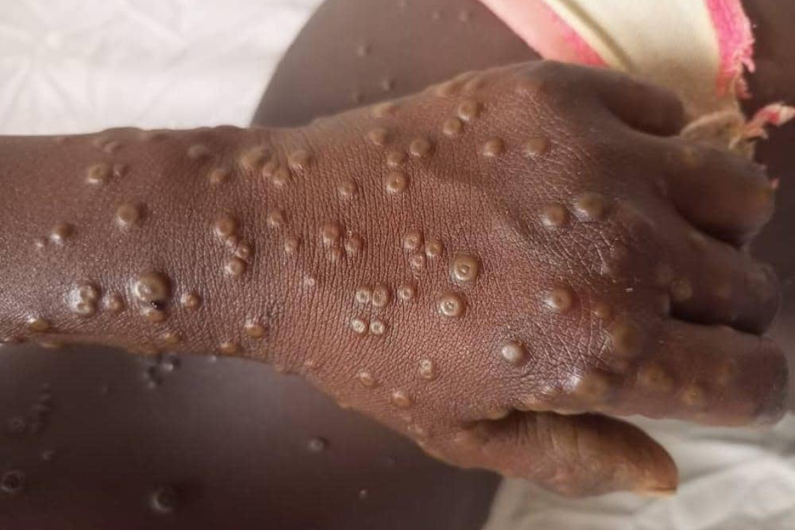 Nord-Kivu/Épidémie de Mpox : 72 cas confirmés, les autorités intensifient la riposte